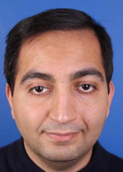 After Hair Transplant&nbsp;Front